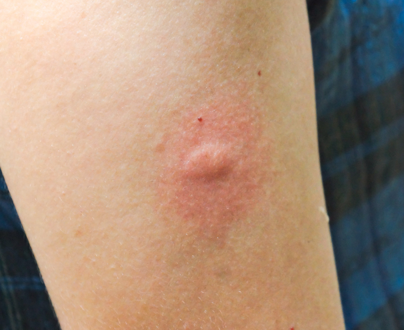 Imagen de una picadura en un humano.