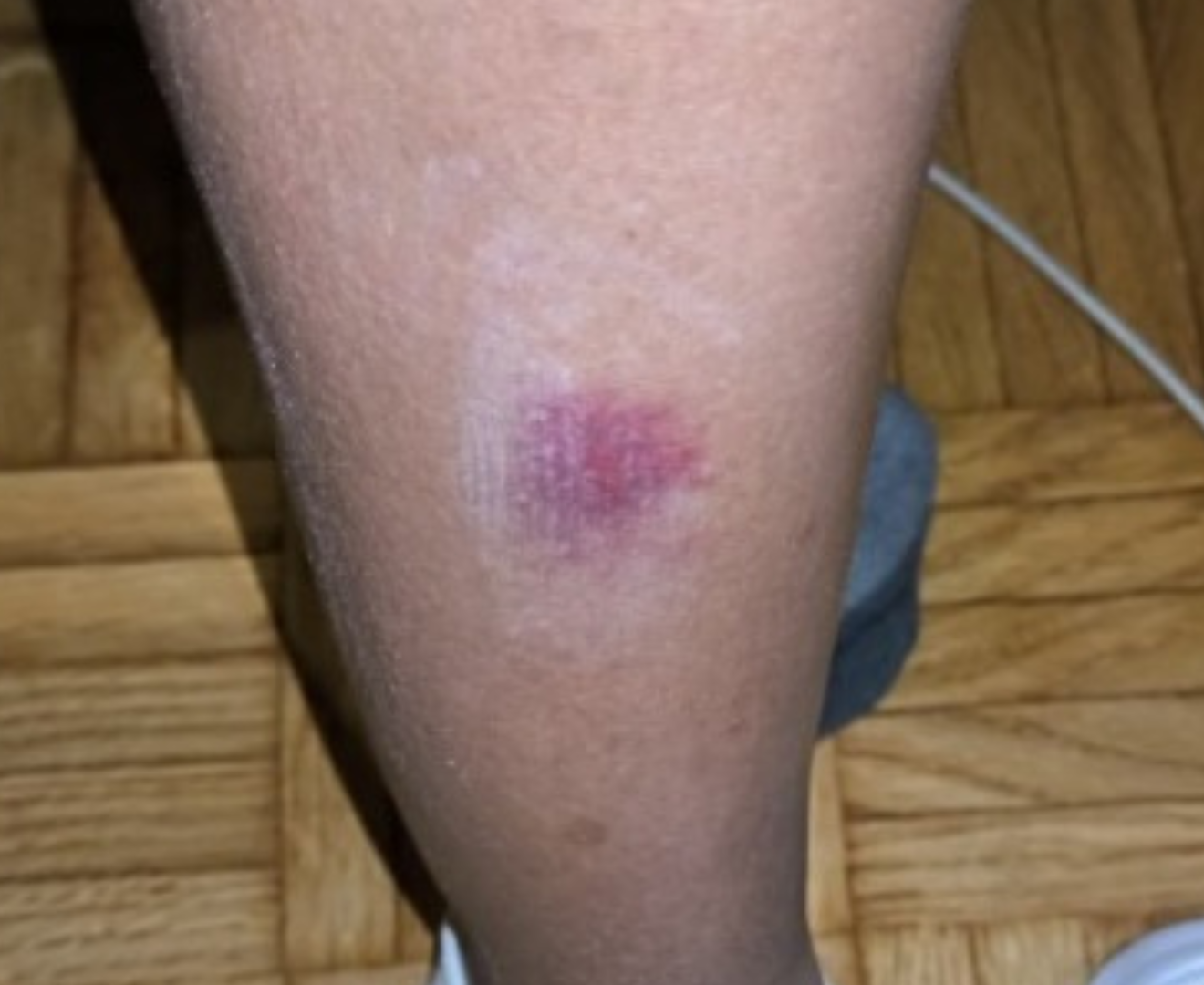 Imagen de la pierna de una persona que ha sido picada por una mosca negra.