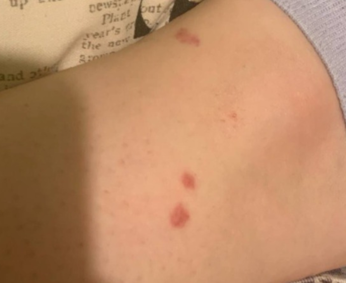 Imagen de una extremidad de una persona que hace tiempo ha sido picada por la mosca negra.