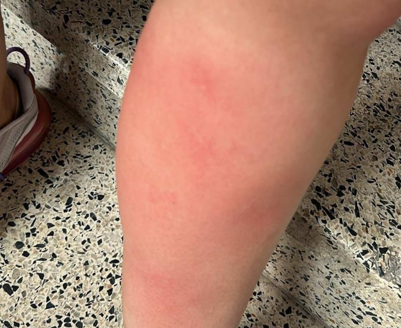 Imagen de una extremidad humana que ha sido mordida por una mosca negra y ha generado reacción.